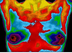 breast thermography image